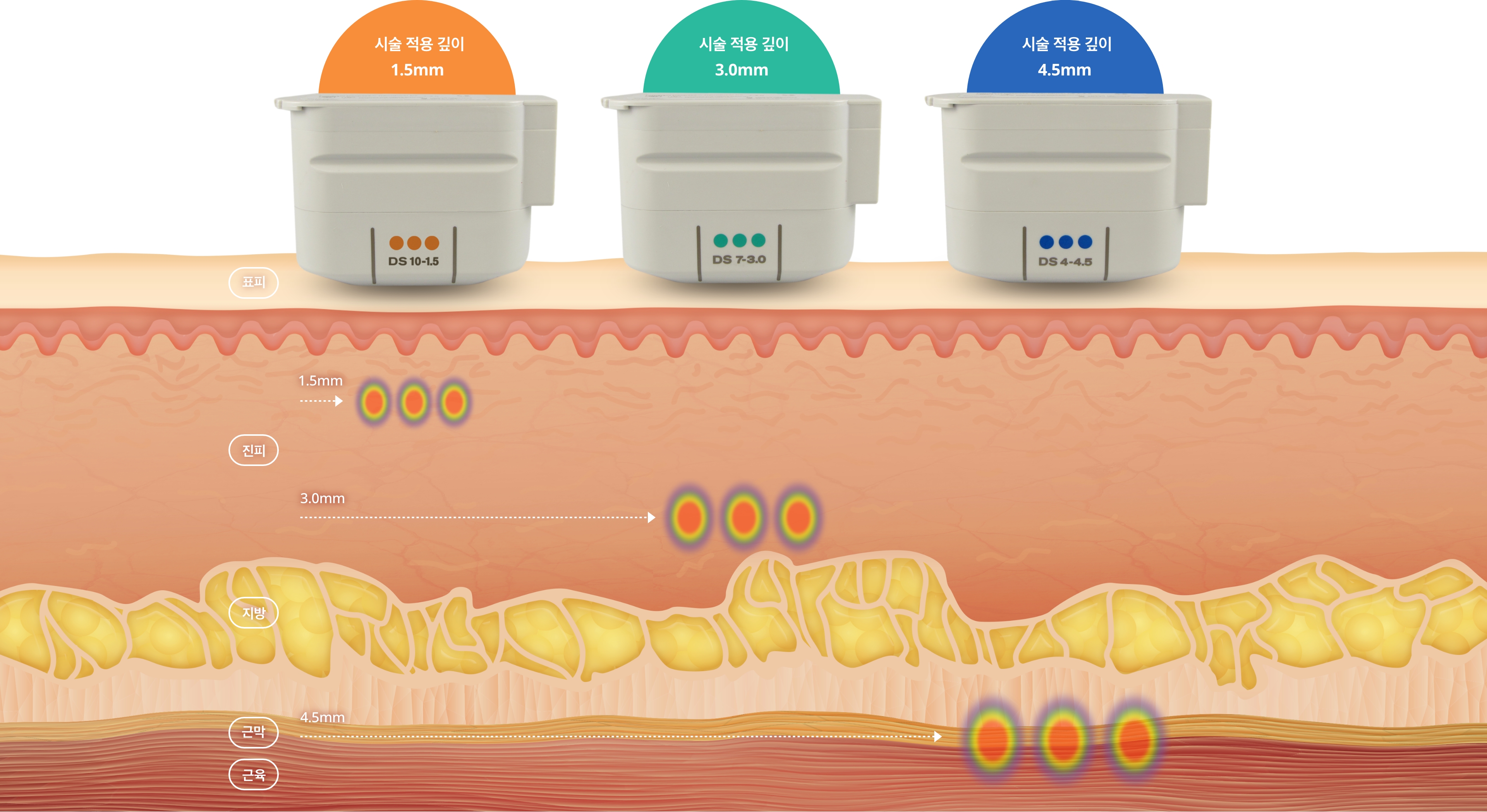 맞춤시술 이미지