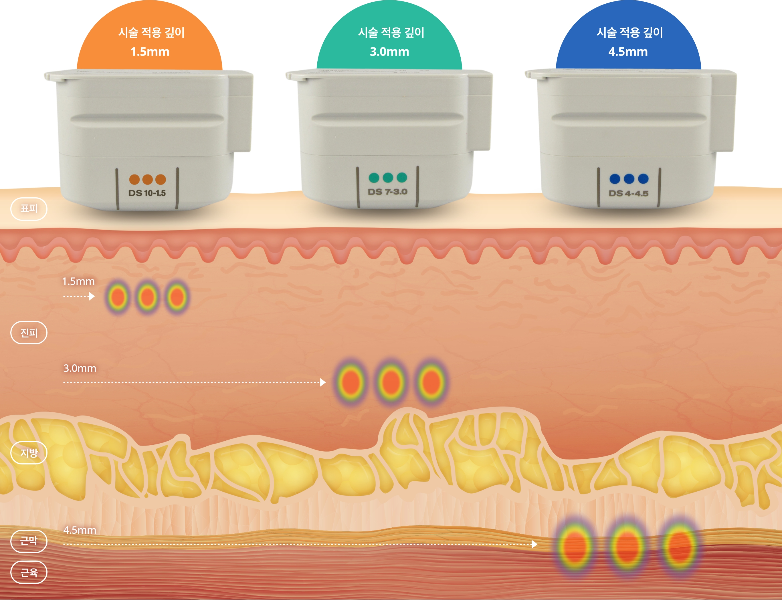 맞춤시술 이미지
